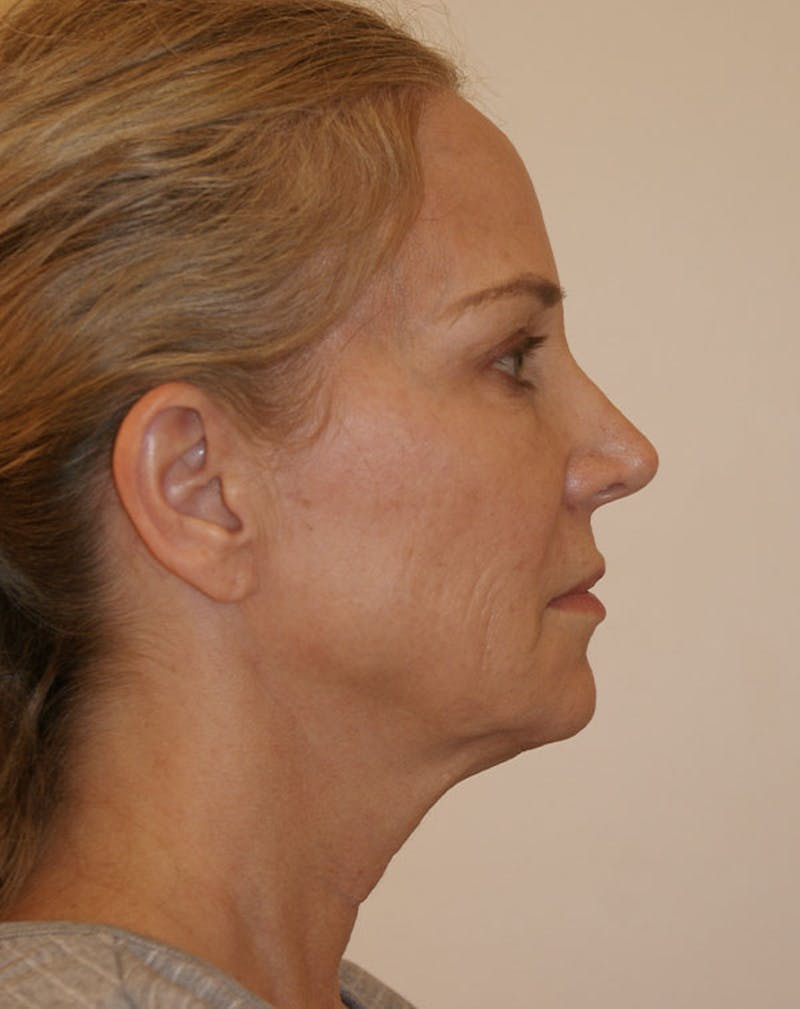 Facelift/Necklift Before & After Gallery - Patient 707826 - Image 7