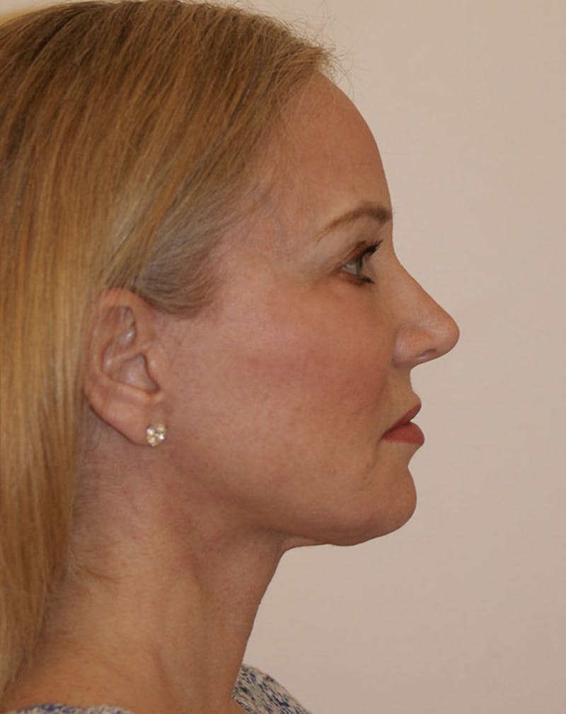 Facelift/Necklift Before & After Gallery - Patient 707826 - Image 8