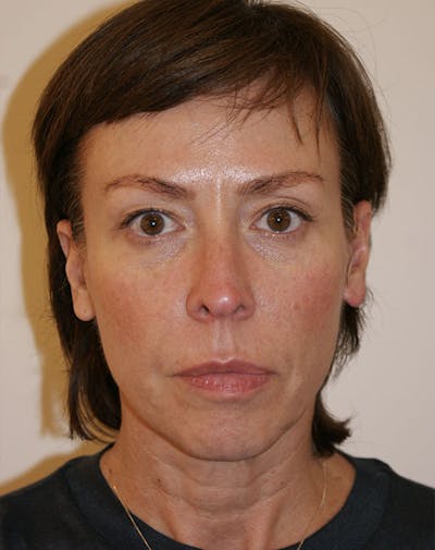Facelift/Necklift Before & After Gallery - Patient 244587 - Image 1