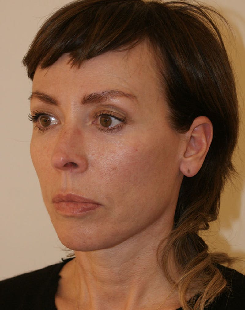 Facelift/Necklift Before & After Gallery - Patient 244587 - Image 6