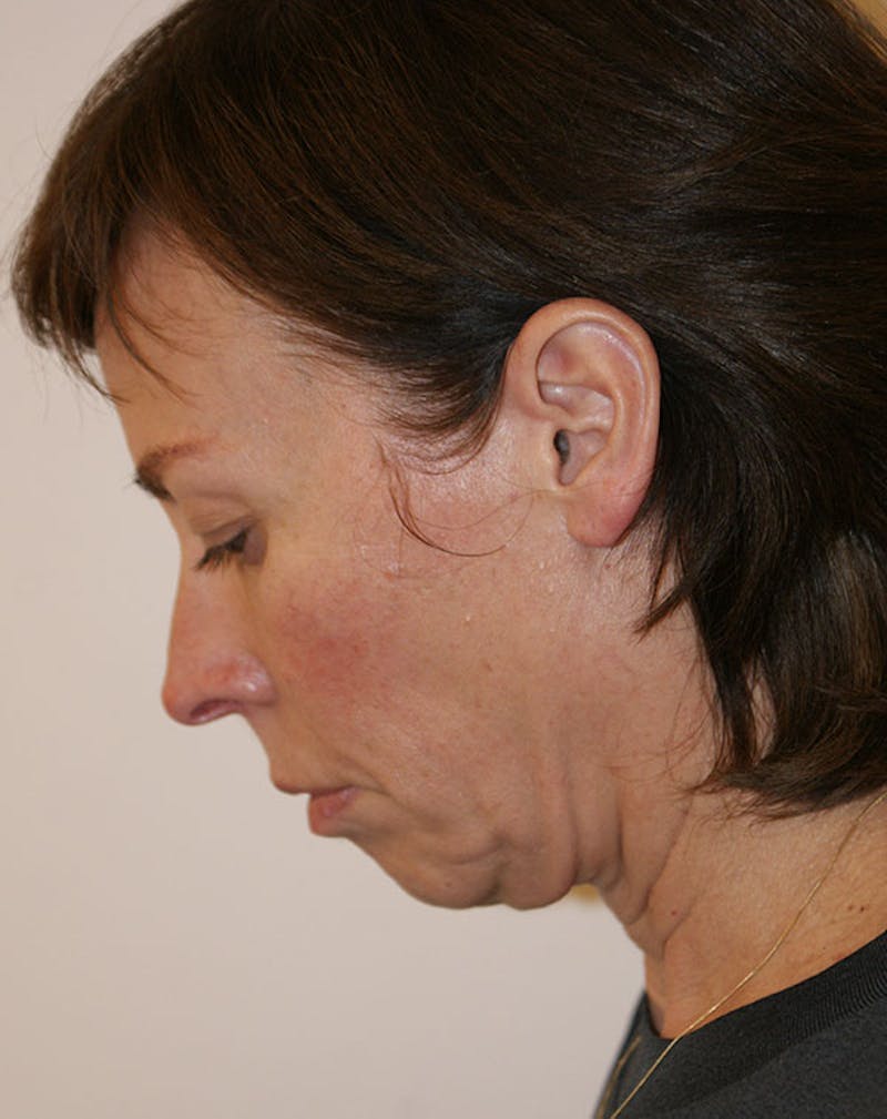 Facelift/Necklift Before & After Gallery - Patient 244587 - Image 9