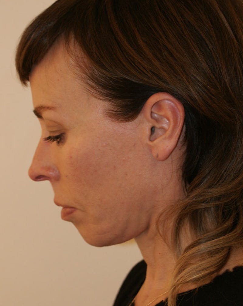 Facelift/Necklift Before & After Gallery - Patient 244587 - Image 10