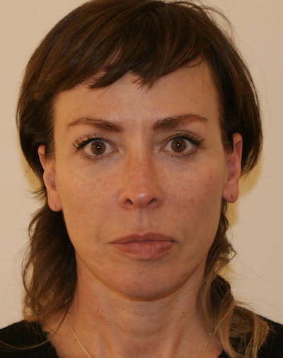 Facelift/Necklift Before & After Gallery - Patient 244587 - Image 2