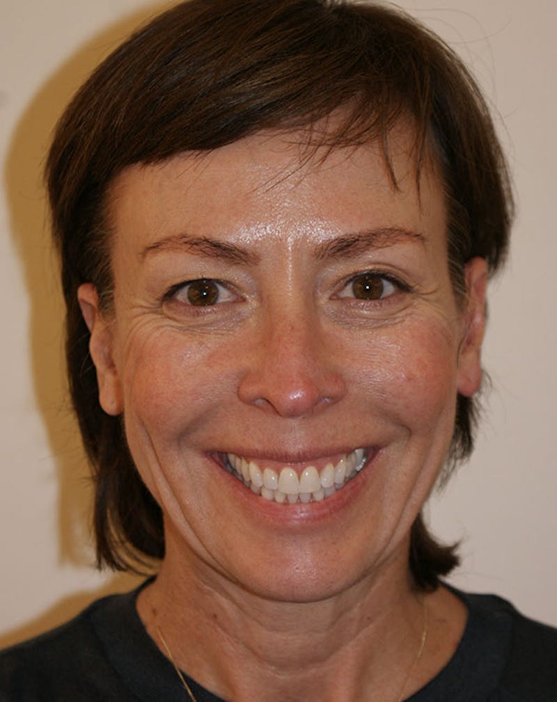 Facelift/Necklift Before & After Gallery - Patient 244587 - Image 3