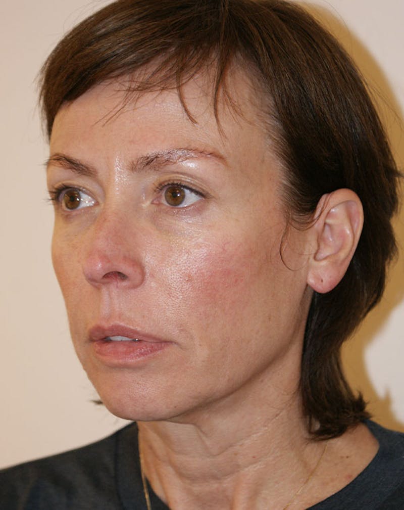 Facelift/Necklift Before & After Gallery - Patient 244587 - Image 5