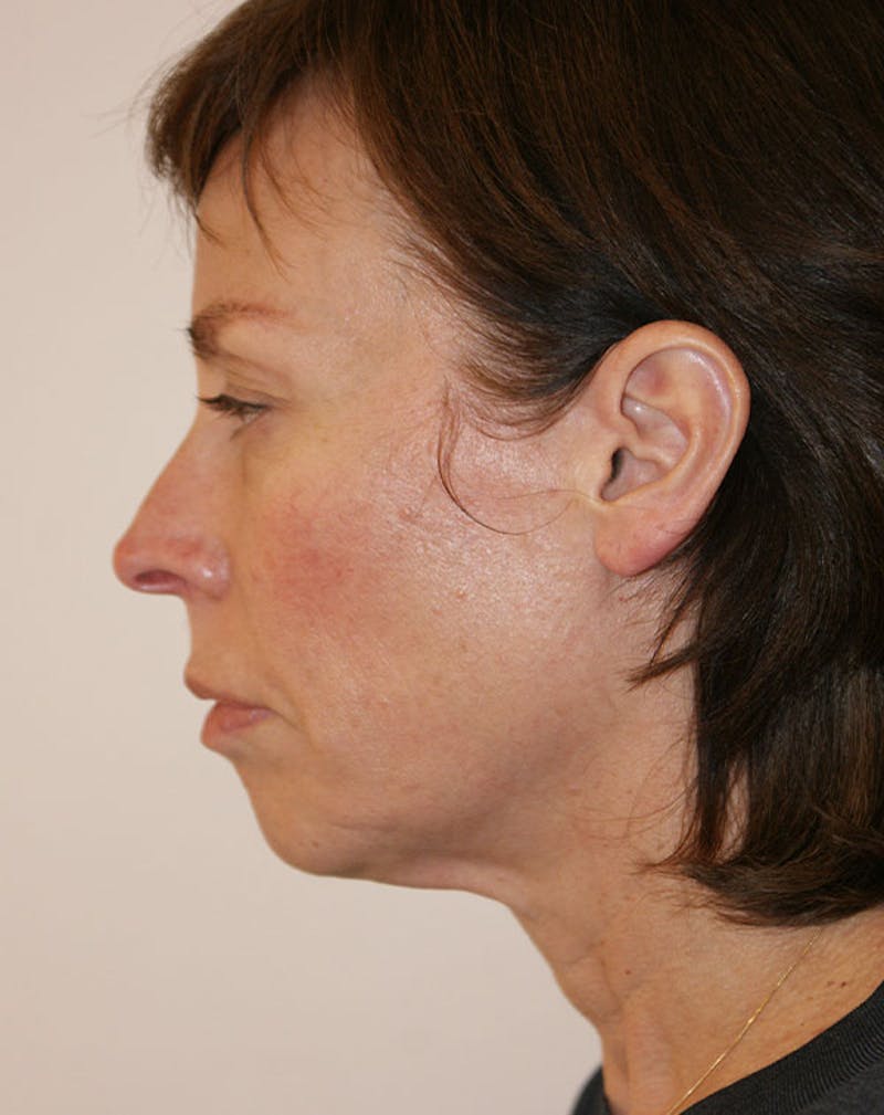 Facelift/Necklift Before & After Gallery - Patient 244587 - Image 7