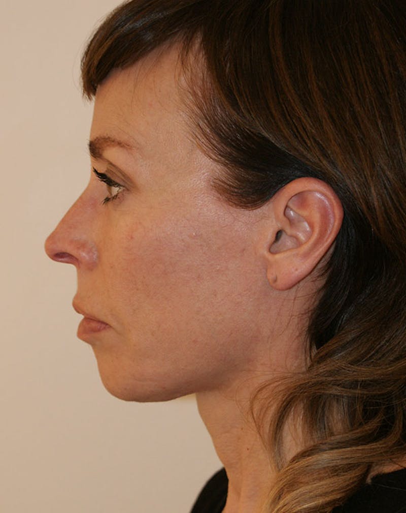 Facelift/Necklift Before & After Gallery - Patient 244587 - Image 8