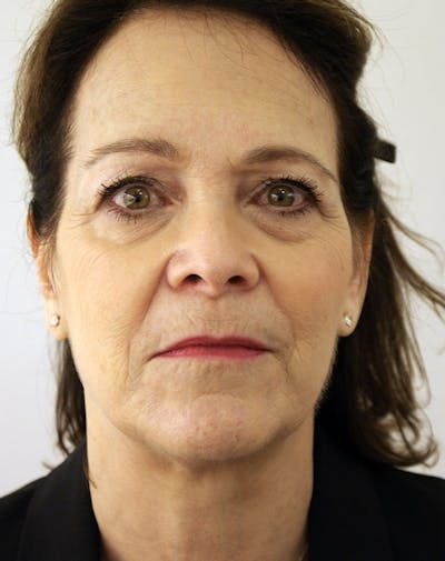 Facelift/Necklift Before & After Gallery - Patient 291751 - Image 1