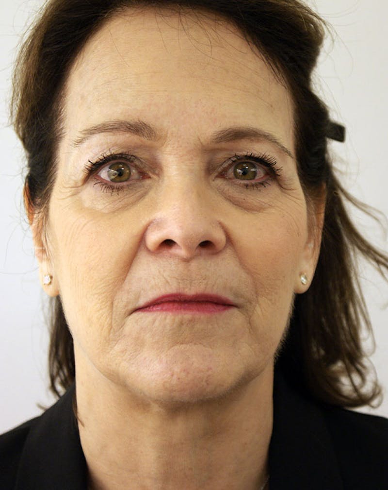 Facelift/Necklift Before & After Gallery - Patient 291751 - Image 1