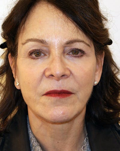Facelift/Necklift Before & After Gallery - Patient 291751 - Image 2