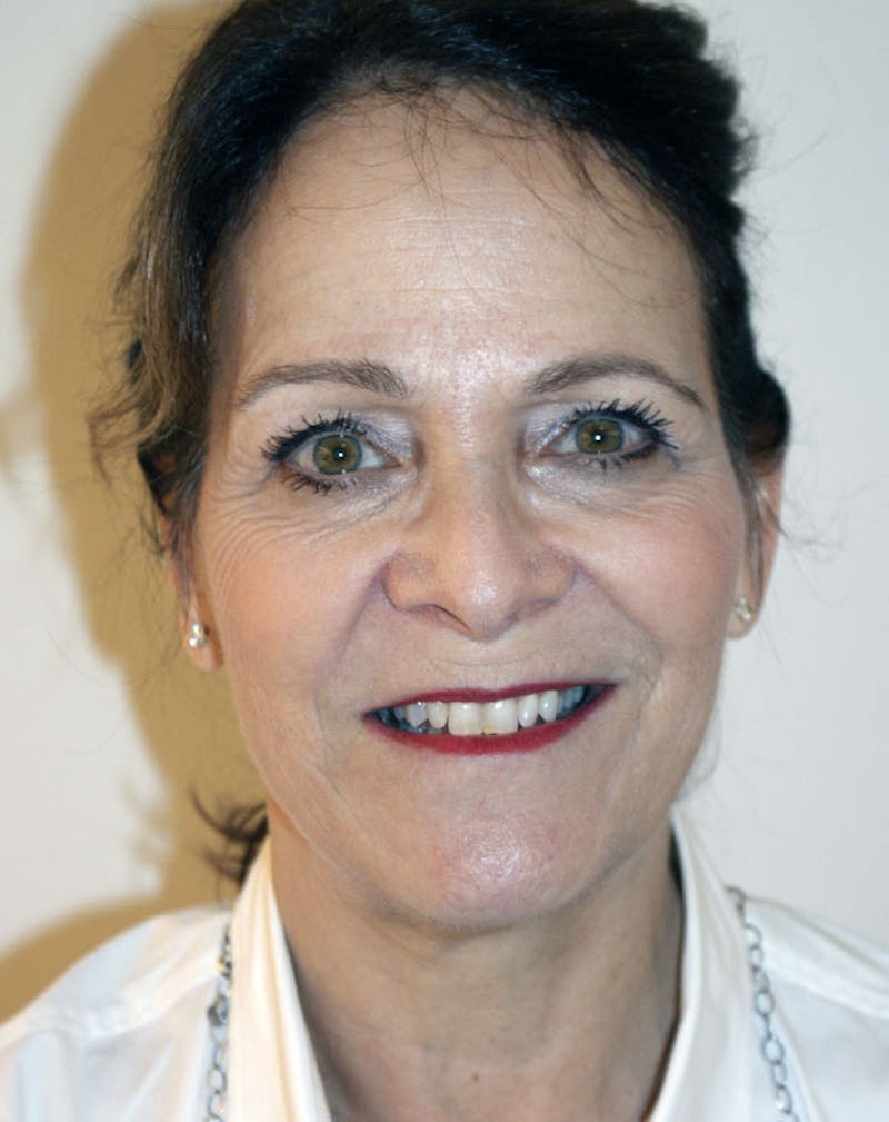 Facelift/Necklift Before & After Gallery - Patient 291751 - Image 3