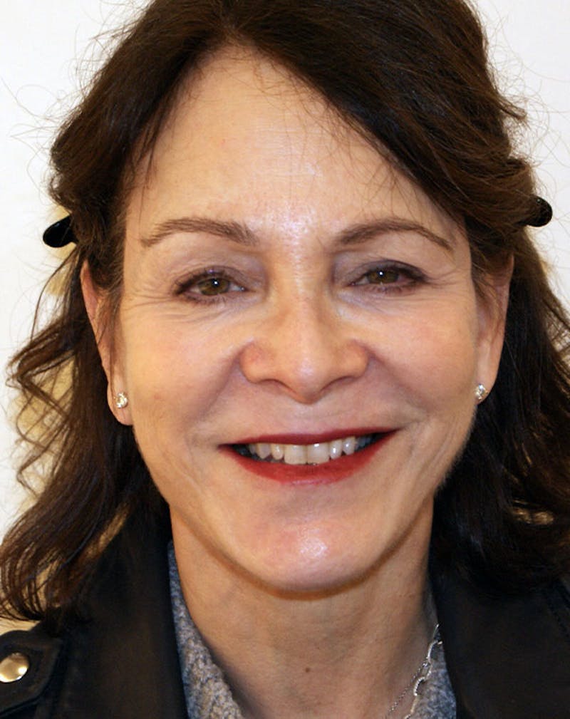 Facelift/Necklift Before & After Gallery - Patient 291751 - Image 4