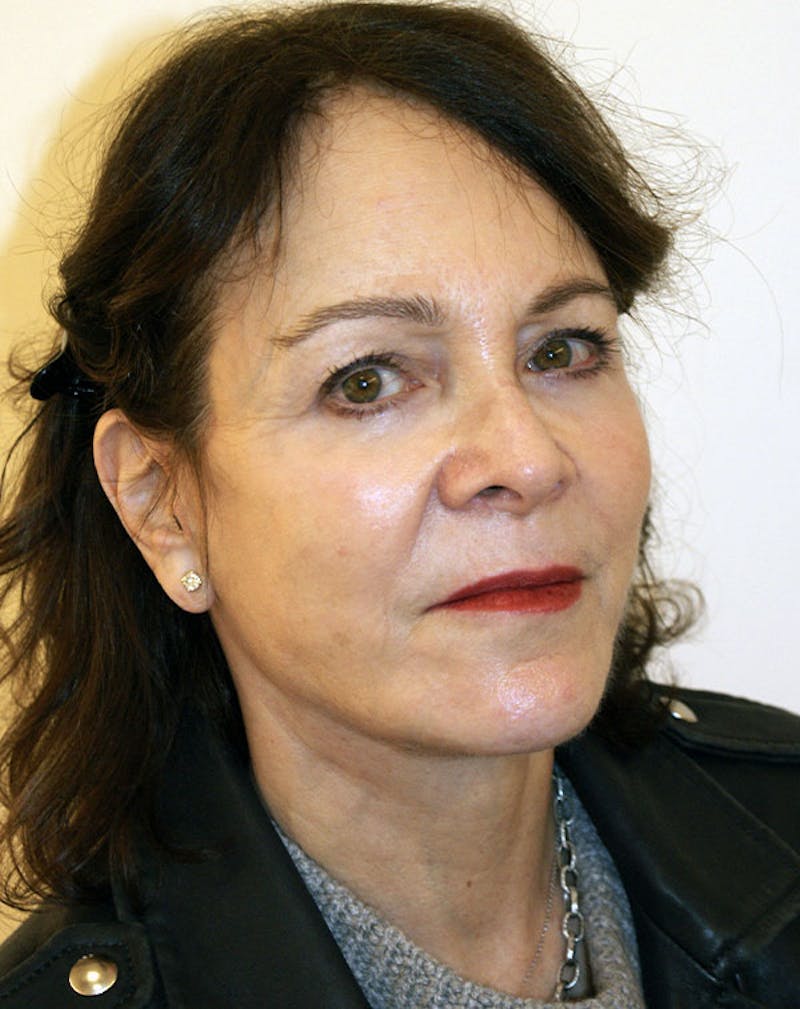 Facelift/Necklift Before & After Gallery - Patient 291751 - Image 6