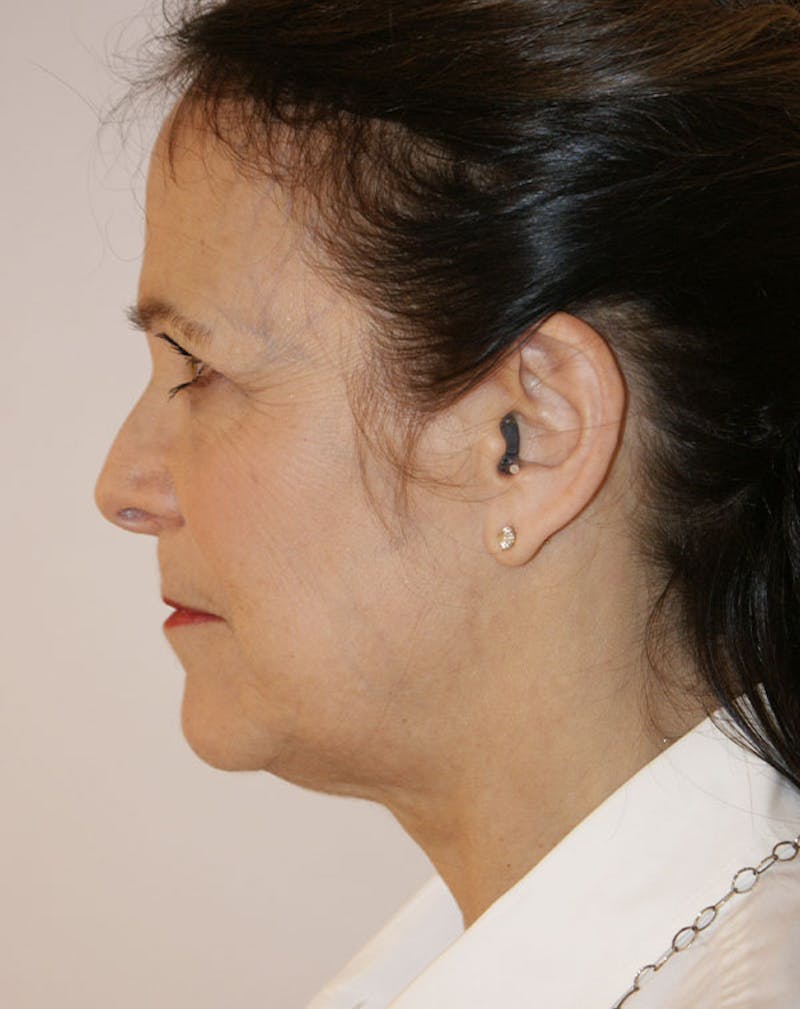 Facelift/Necklift Before & After Gallery - Patient 291751 - Image 7
