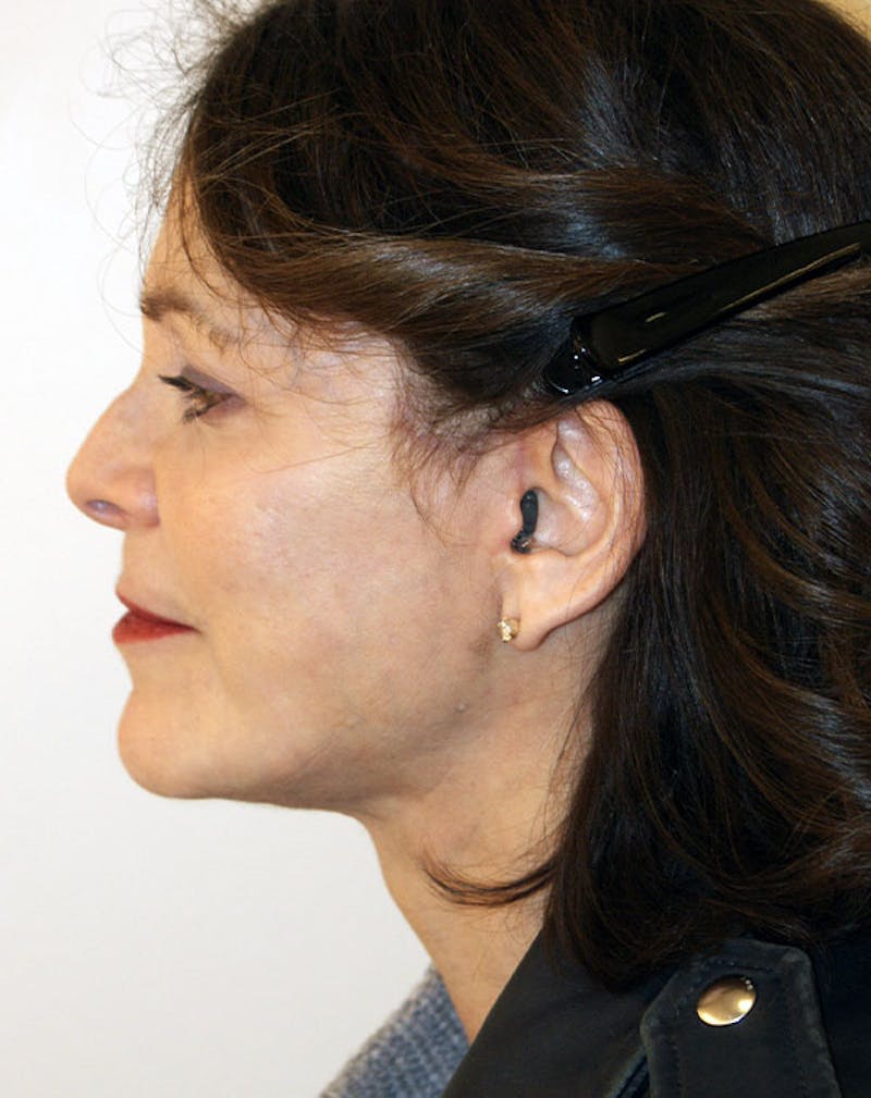 Facelift/Necklift Before & After Gallery - Patient 291751 - Image 8