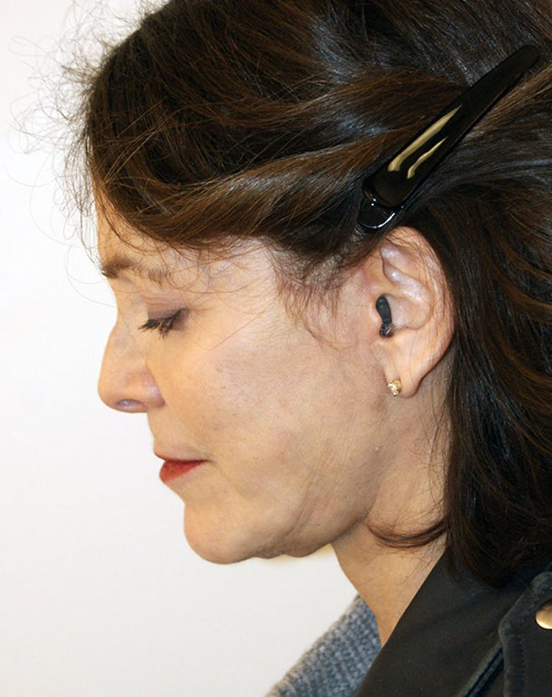 Facelift/Necklift Before & After Gallery - Patient 291751 - Image 10