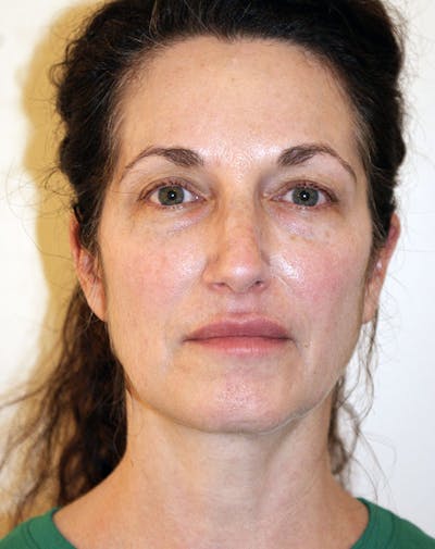 Facelift/Necklift Before & After Gallery - Patient 365737 - Image 1