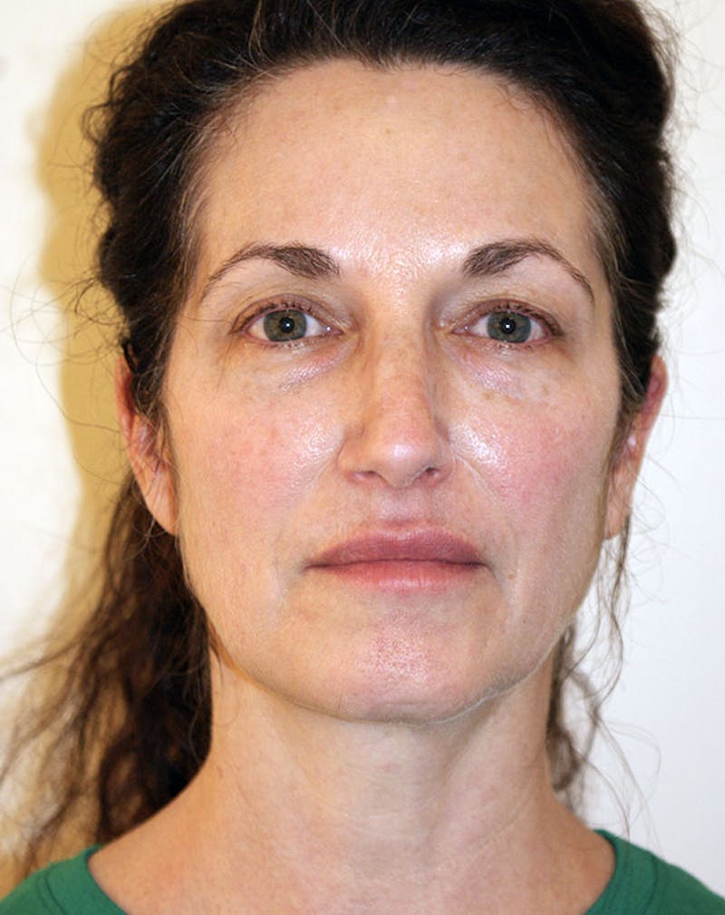 Facelift/Necklift Before & After Gallery - Patient 365737 - Image 1