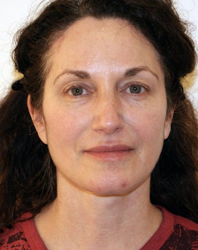 Facelift/Necklift Before & After Gallery - Patient 365737 - Image 2