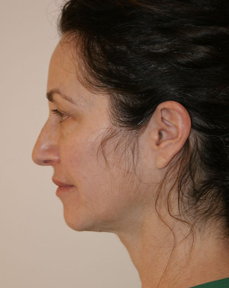 Facelift/Necklift Before & After Gallery - Patient 365737 - Image 7