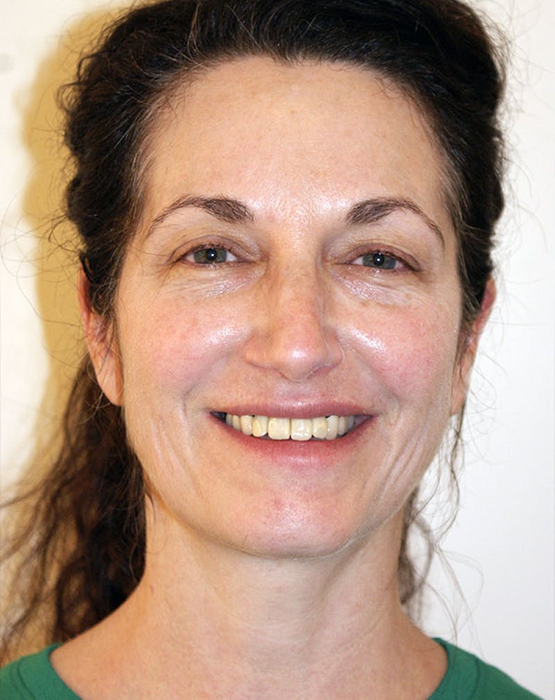 Facelift/Necklift Before & After Gallery - Patient 365737 - Image 3
