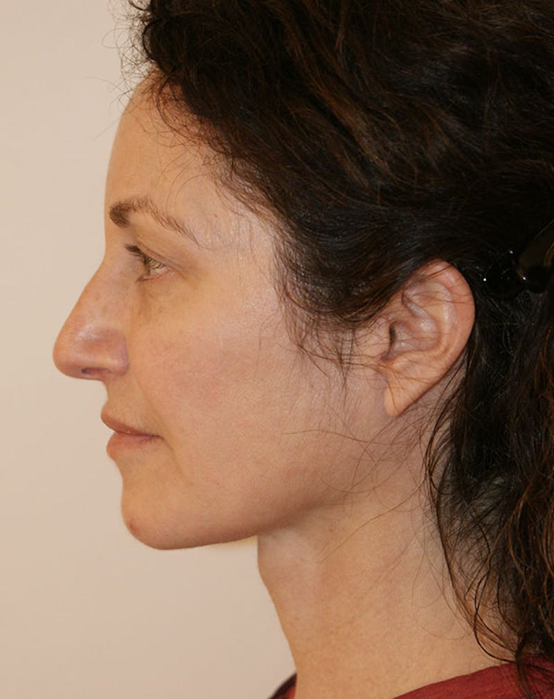 Facelift/Necklift Before & After Gallery - Patient 365737 - Image 8