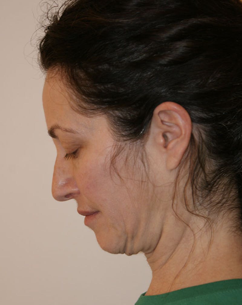 Facelift/Necklift Before & After Gallery - Patient 365737 - Image 9