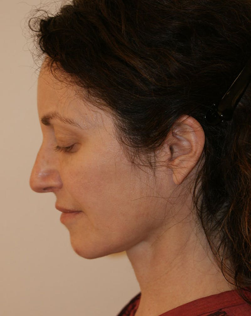 Facelift/Necklift Before & After Gallery - Patient 365737 - Image 10