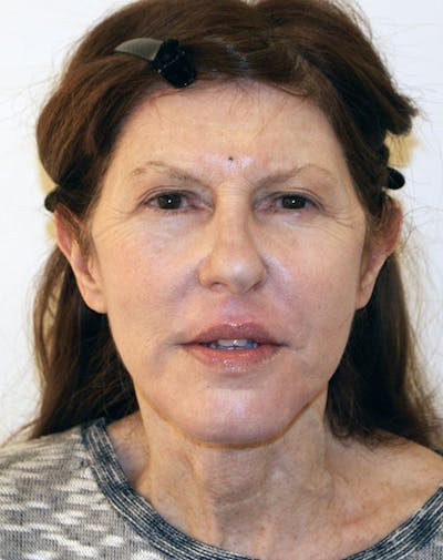 Facelift/Necklift Before & After Gallery - Patient 181330 - Image 2