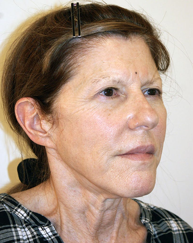 Facelift/Necklift Before & After Gallery - Patient 181330 - Image 5