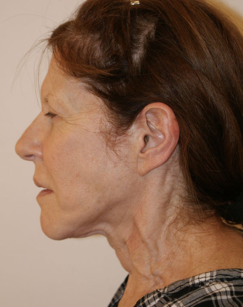 Facelift/Necklift Before & After Gallery - Patient 181330 - Image 7