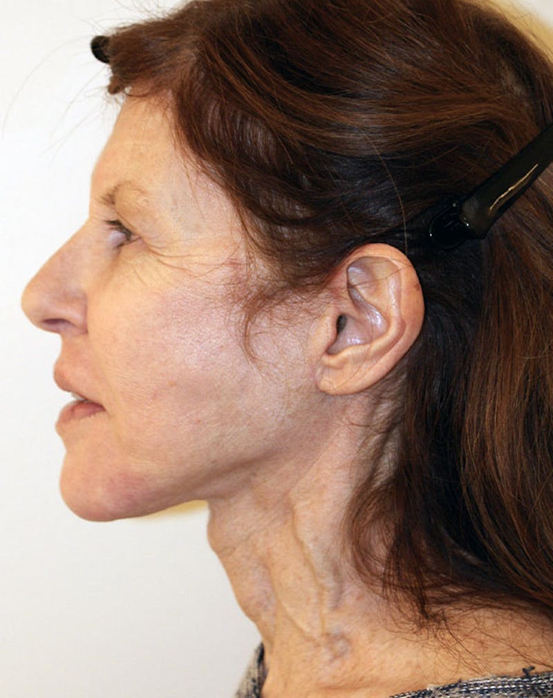 Facelift/Necklift Before & After Gallery - Patient 181330 - Image 8