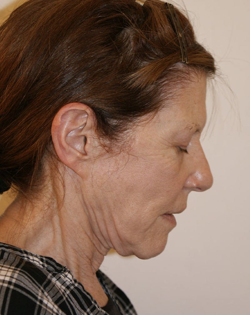Facelift/Necklift Before & After Gallery - Patient 181330 - Image 9