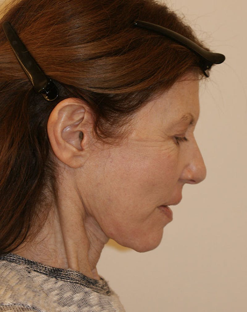 Facelift/Necklift Before & After Gallery - Patient 181330 - Image 10