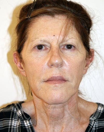 Facelift/Necklift Before & After Gallery - Patient 181330 - Image 1