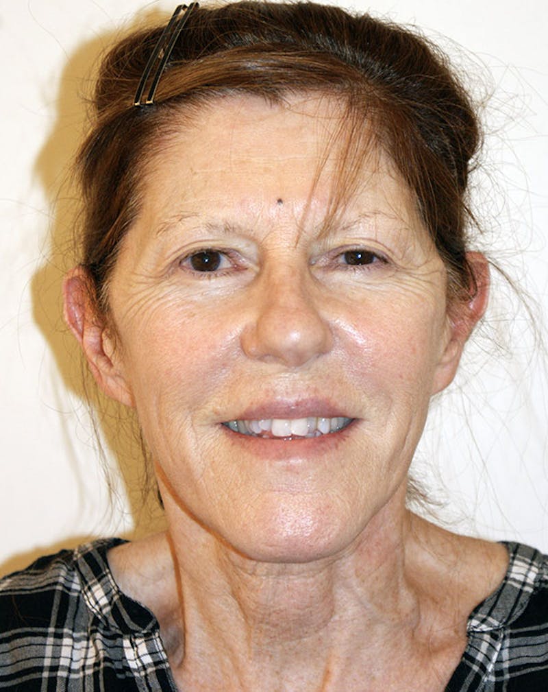 Facelift/Necklift Before & After Gallery - Patient 181330 - Image 3