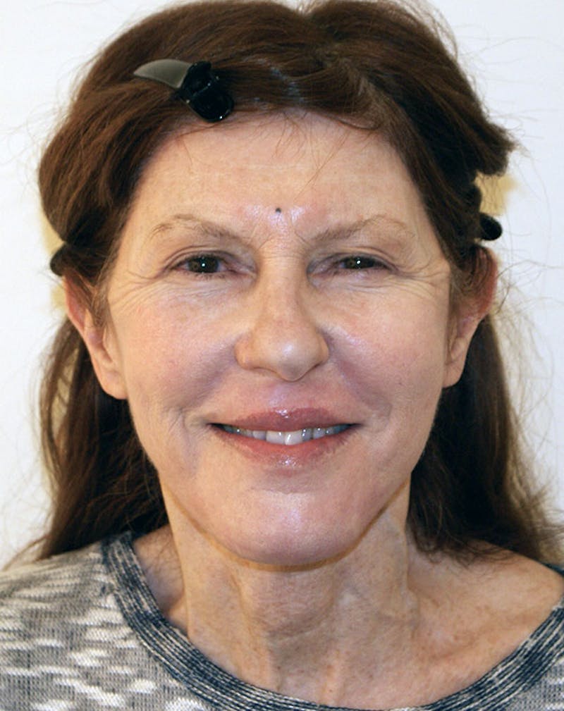 Facelift/Necklift Before & After Gallery - Patient 181330 - Image 4