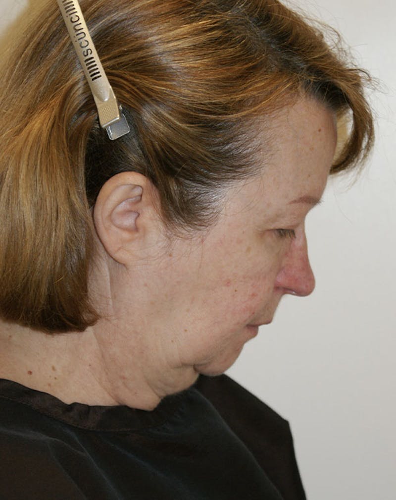 Facelift/Necklift Before & After Gallery - Patient 383910 - Image 7