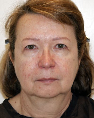 Facelift/Necklift Before & After Gallery - Patient 383910 - Image 1