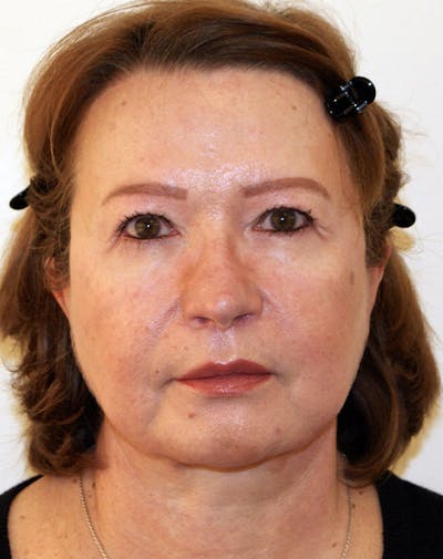 Facelift/Necklift Before & After Gallery - Patient 383910 - Image 2
