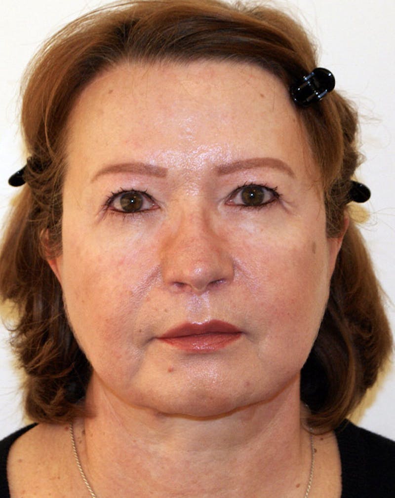 Facelift/Necklift Before & After Gallery - Patient 383910 - Image 2