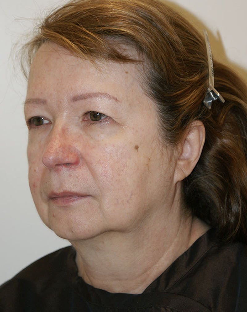 Facelift/Necklift Before & After Gallery - Patient 383910 - Image 3