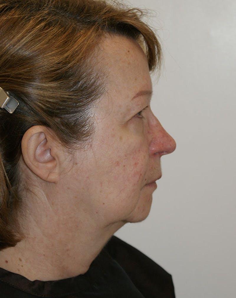 Facelift/Necklift Before & After Gallery - Patient 383910 - Image 5