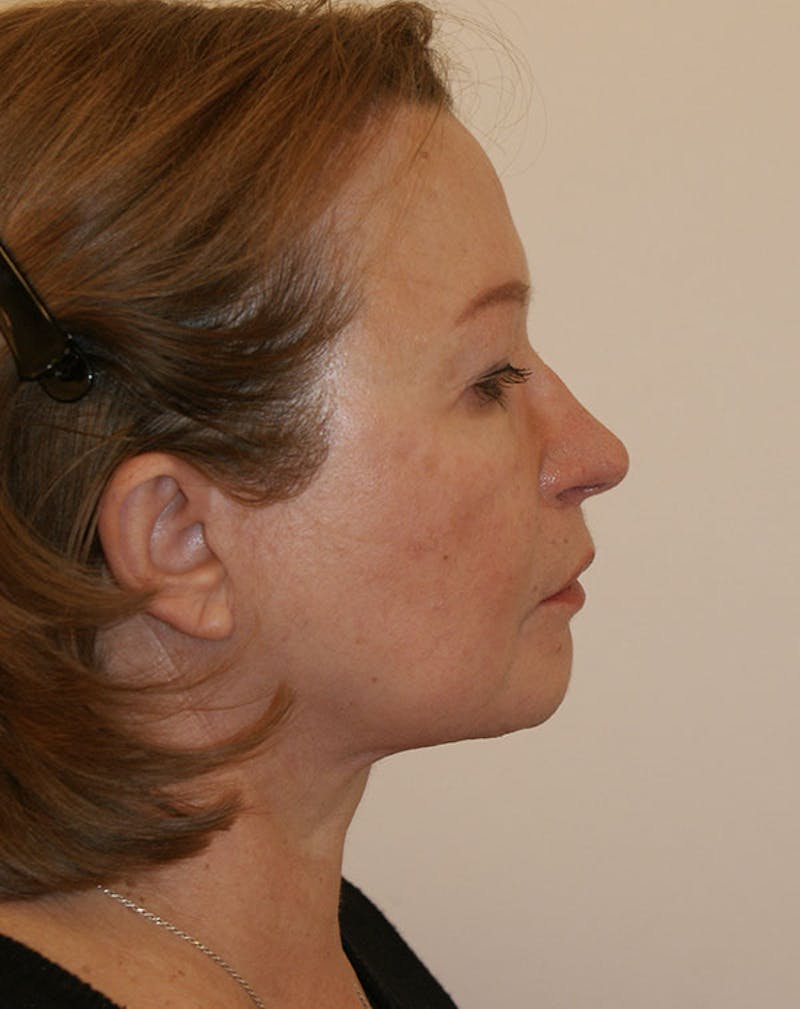 Facelift/Necklift Before & After Gallery - Patient 383910 - Image 6