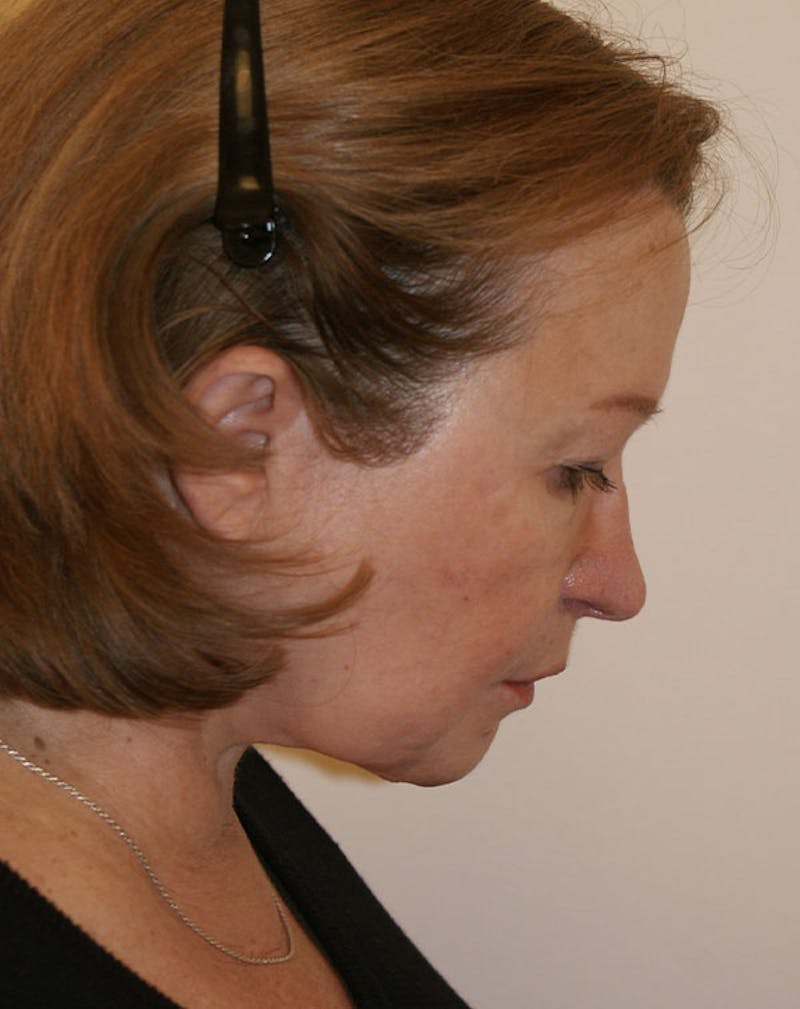 Facelift/Necklift Before & After Gallery - Patient 383910 - Image 8