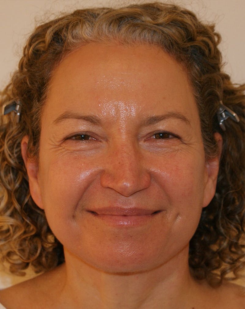 Facelift/Necklift Before & After Gallery - Patient 309331 - Image 4