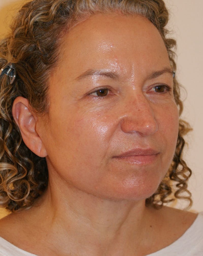 Facelift/Necklift Before & After Gallery - Patient 309331 - Image 6