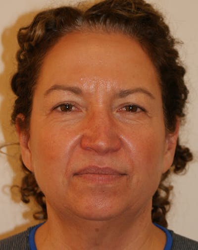 Facelift/Necklift Before & After Gallery - Patient 309331 - Image 1