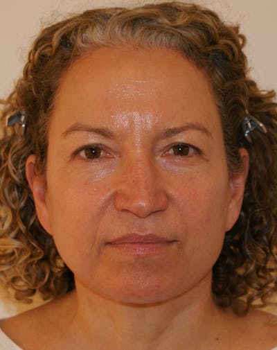 Facelift/Necklift Before & After Gallery - Patient 309331 - Image 2