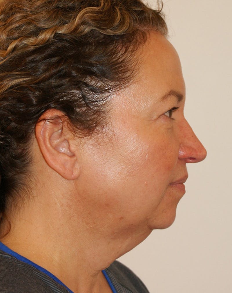 Facelift/Necklift Before & After Gallery - Patient 309331 - Image 7
